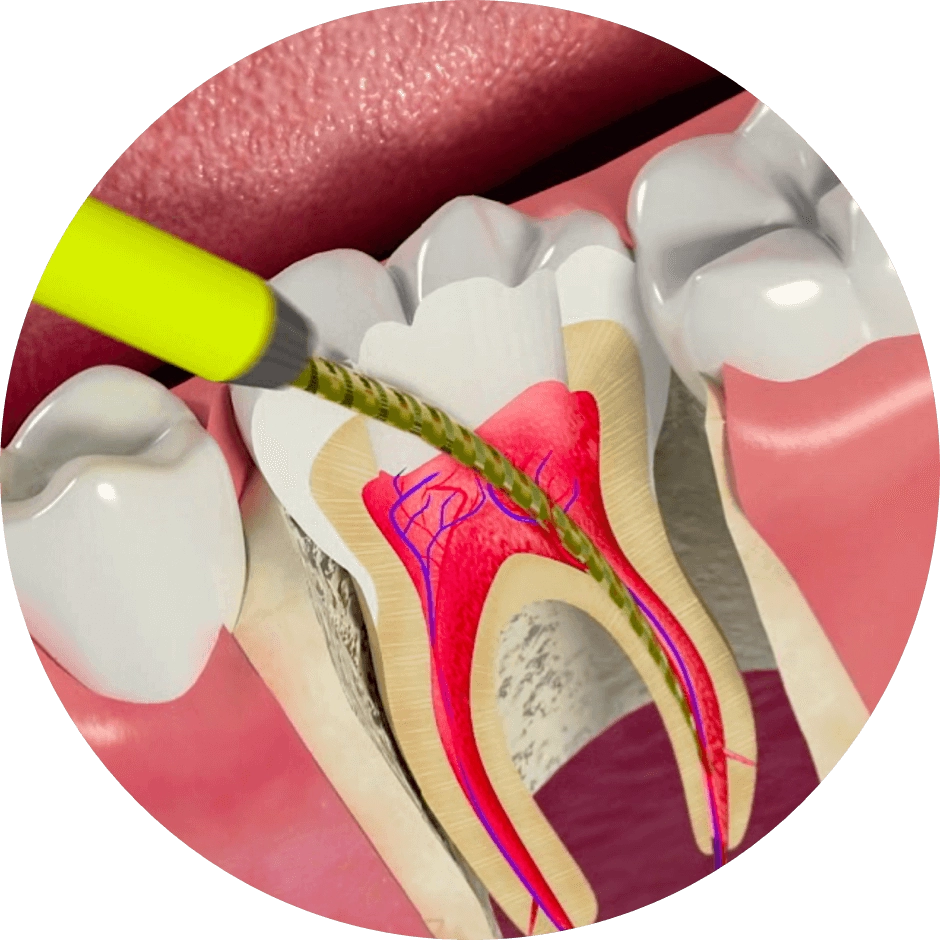 Баннер Лечение каналов — пульпита и периодонтита